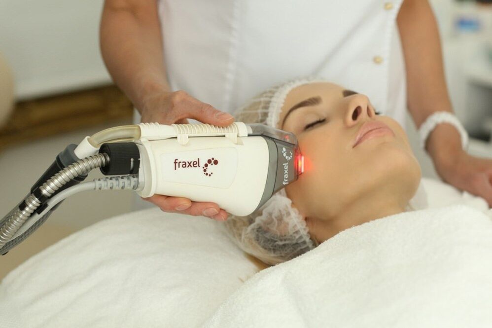 Laser noorendamine