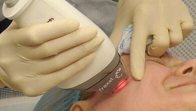 Kuidas toimub fraktsionaalne naha noorendamine