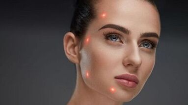 Mis on fraktsionaalne naha noorendamine