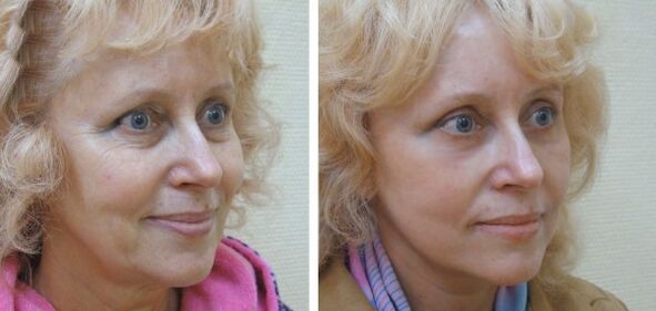 Naine enne ja pärast plasma näonaha noorendamist