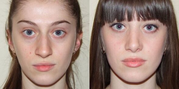 Tüdruk enne ja pärast plasma näonaha noorendamist